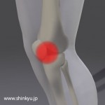 Knee pain/water accumulates on the knees