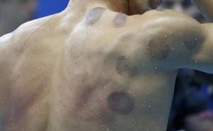 2016 Rio Olympics - Swimming - Preliminary - Men's 200m Butterfly - Heats - Olympic Aquatics Stadium - Rio de Janeiro, Brazil - 08/08/2016. Michael Phelps (USA) of USA is seen with red cupping marks on his shoulder as he competes. REUTERS/Michael Dalder